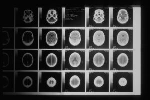 brain x ray scans